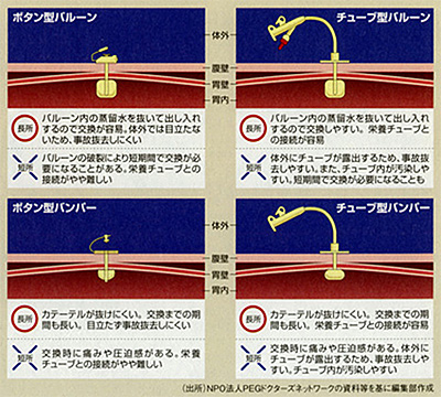 胃瘻の種類