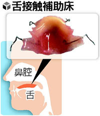 舌接触補助床（ぜつせっしょくほじょしょう）